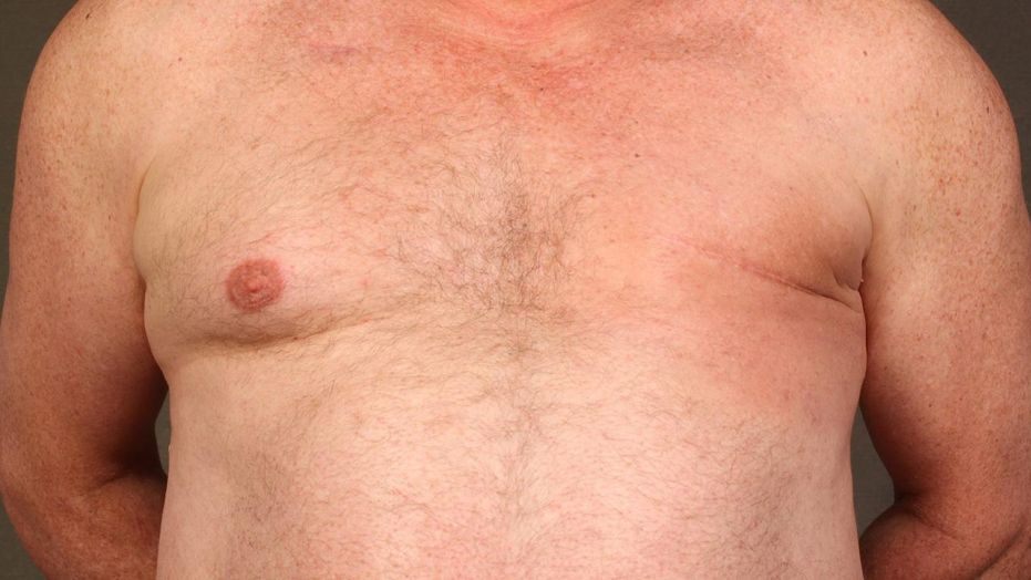Tórax de um homem adulto com cicatriz de cirurgia na região do peito